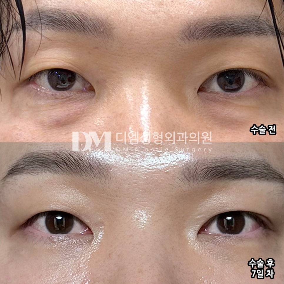 디엠 눈밑지방재배치 수술후기, “가격, 결과 모든 게 좋았습니다!” 관련 이미지 2
