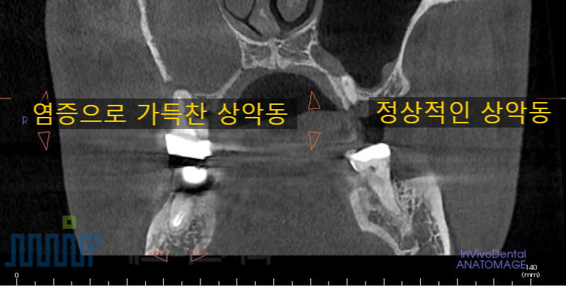 잇몸 염증이 코까지 번졌다고요? - 상악동거상술 + 뼈이식 관련 이미지 2