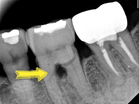 잇몸뼈 재생을 돕는 치주 재생 유도제, 엠도게인 관련 이미지 2