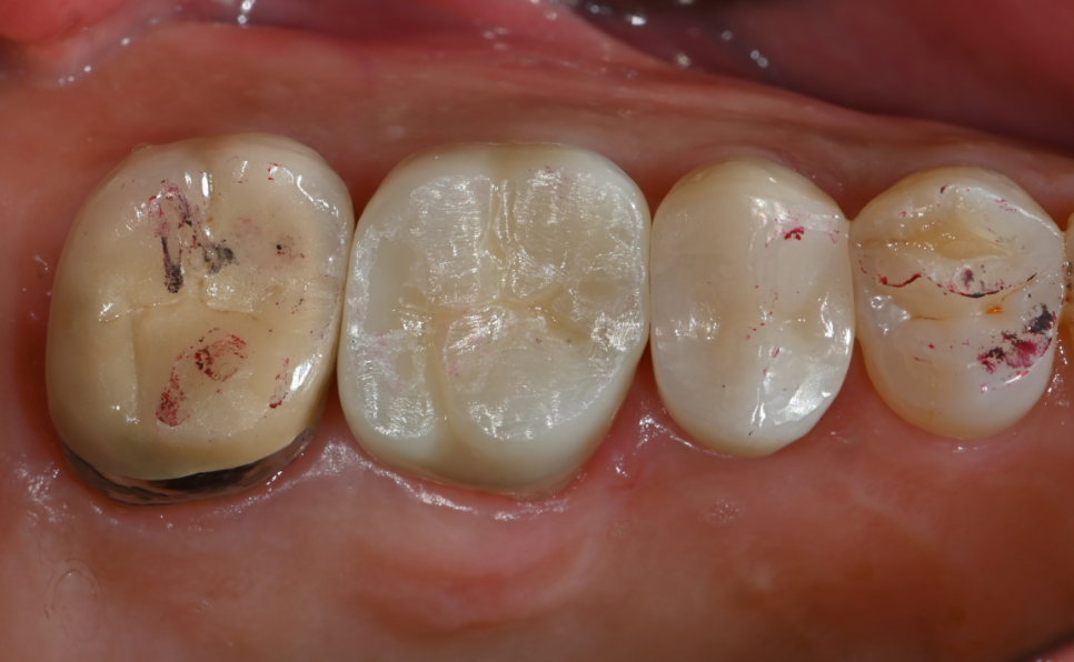 금이 간 치아! 치아를 잃을 뻔 했던 순간, 예스미르치과 관련 이미지 7