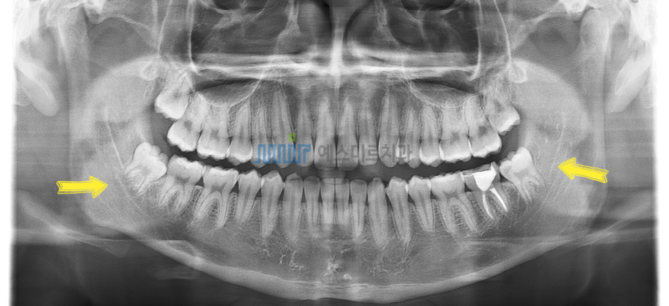 사랑니 빼면 얼굴이 갸름해지나요? 정말 작아지나요? 관련 이미지 1