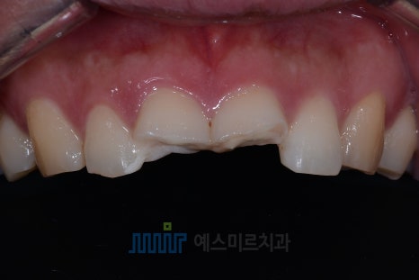 넘어져서 앞니가 부러졌어요 &ndash; 앞니 크라운 관련 이미지 3
