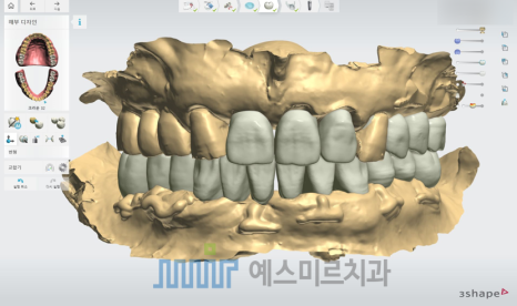 🦷 임플란트 수술 전 과정을 생중계로! &ndash; 예스미르치과 x 덴올TV 관련 이미지 4