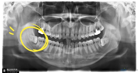 사랑니 발치, 꼭 빼야 할까요? - 사랑니 발치 관련 이미지 1