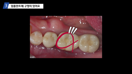 임플란트 완료 후 주의사항 총정리 - 보철과 전문의가 알려주는 오래쓰는 관리법 관련 이미지 1