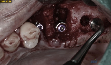 잇몸 염증이 코까지 번졌다고요? - 상악동거상술 + 뼈이식 관련 이미지 6