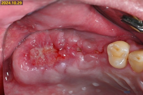 잇몸 염증이 코까지 번졌다고요? - 상악동거상술 + 뼈이식 관련 이미지 9