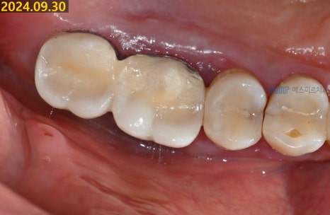 임플란트가 흔들려요 - 임플란트 재수술 관련 이미지 11