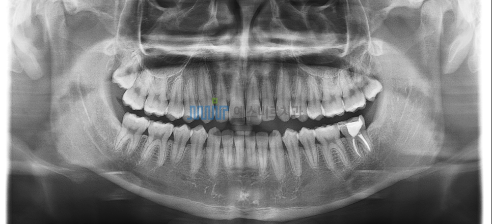 사랑니 빼면 얼굴이 갸름해지나요? 정말 작아지나요? 관련 이미지 2