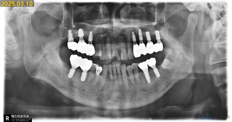 임플란트가 흔들려요 - 임플란트 재수술 관련 이미지 10