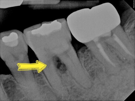 잇몸뼈 재생을 돕는 치주 재생 유도제, 엠도게인 관련 이미지 3