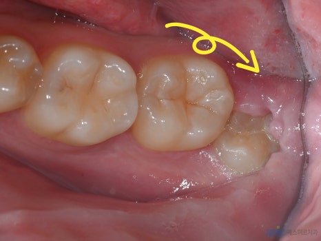 사랑니 발치, 꼭 빼야 할까요? - 사랑니 발치 관련 이미지 4
