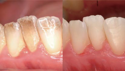 예스케어 예방 프로그램 ㅣ 치아는 관리가 먼저! 관련 이미지 8