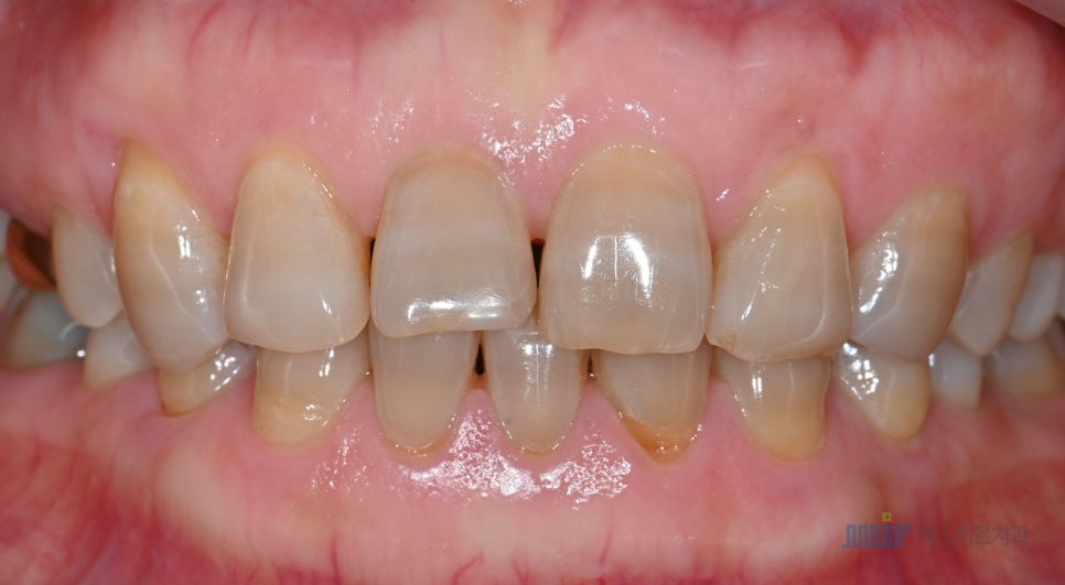 ✨앞니 색상, 자연스럽게? 새하얗게? 고민된다면 - 미라클네이트 관련 이미지 8