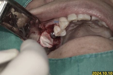 임플란트가 흔들려요 - 임플란트 재수술 관련 이미지 4