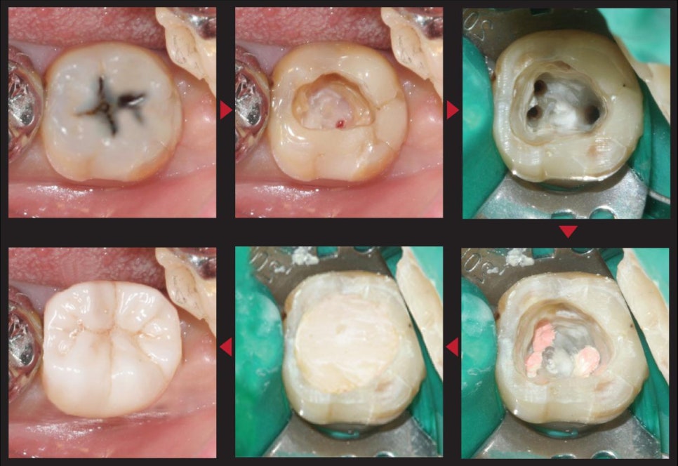 넘어져서 앞니가 부러졌어요 &ndash; 앞니 크라운 관련 이미지 2