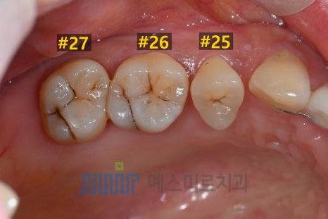 ๐ฆท ์น์์ ๊น๋ง ์ ์ด ๋ณด์ฌ์! - ์๋๋ฏน ์ธ๋ผ๋ฏน ์ธ๋ ์ด ๊ด๋ จ ์ด๋ฏธ์ง 8