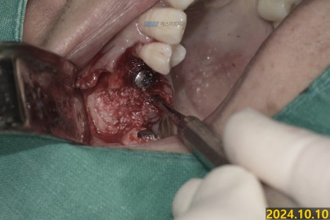 임플란트가 흔들려요 - 임플란트 재수술 관련 이미지 3