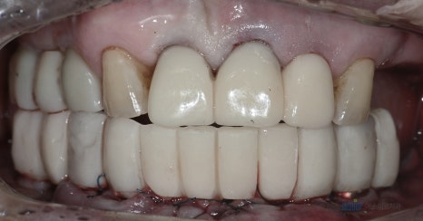 🦷 임플란트 수술 전 과정을 생중계로! &ndash; 예스미르치과 x 덴올TV 관련 이미지 16