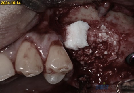 잇몸 염증이 코까지 번졌다고요? - 상악동거상술 + 뼈이식 관련 이미지 7