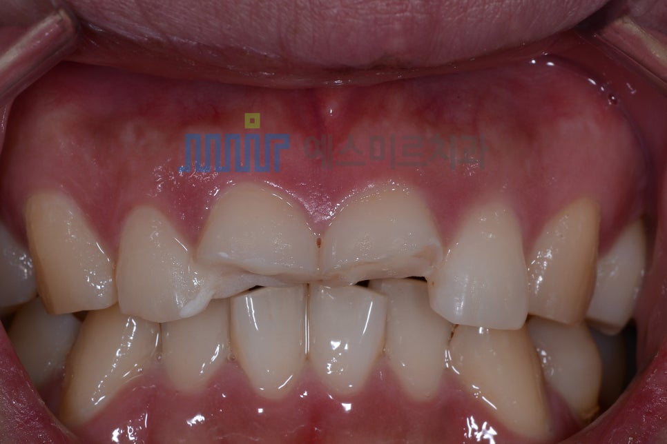 넘어져서 앞니가 부러졌어요 &ndash; 앞니 크라운 관련 이미지 1