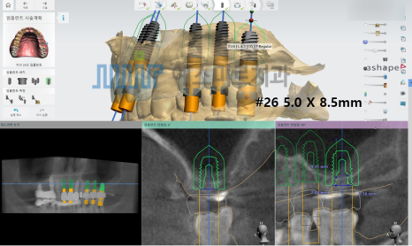 🦷 임플란트 수술 전 과정을 생중계로! &ndash; 예스미르치과 x 덴올TV 관련 이미지 3