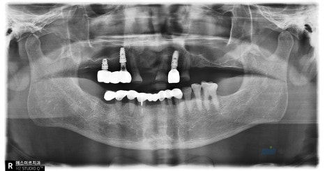 🦷 임플란트 수술 전 과정을 생중계로! &ndash; 예스미르치과 x 덴올TV 관련 이미지 13