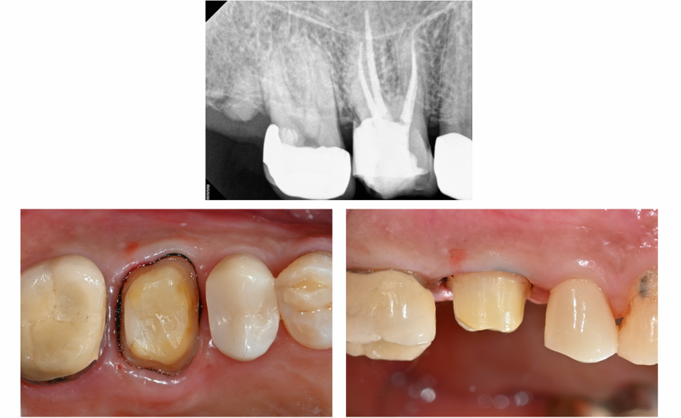 금이 간 치아! 치아를 잃을 뻔 했던 순간, 예스미르치과 관련 이미지 6