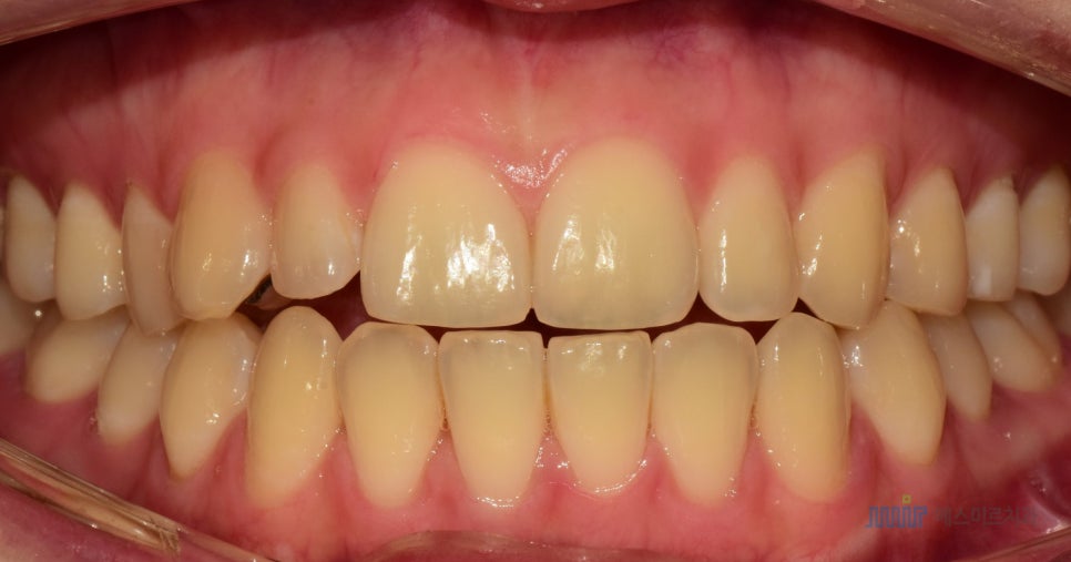 ✨앞니 색상, 자연스럽게? 새하얗게? 고민된다면 - 미라클네이트 관련 이미지 5