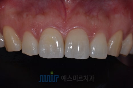 넘어져서 앞니가 부러졌어요 &ndash; 앞니 크라운 관련 이미지 4