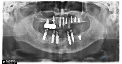🦷 임플란트 수술 전 과정을 생중계로! &ndash; 예스미르치과 x 덴올TV 관련 이미지 15