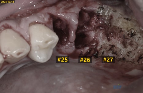잇몸 염증이 코까지 번졌다고요? - 상악동거상술 + 뼈이식 관련 이미지 3