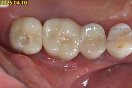 임플란트가 흔들려요 - 임플란트 재수술 관련 이미지 12