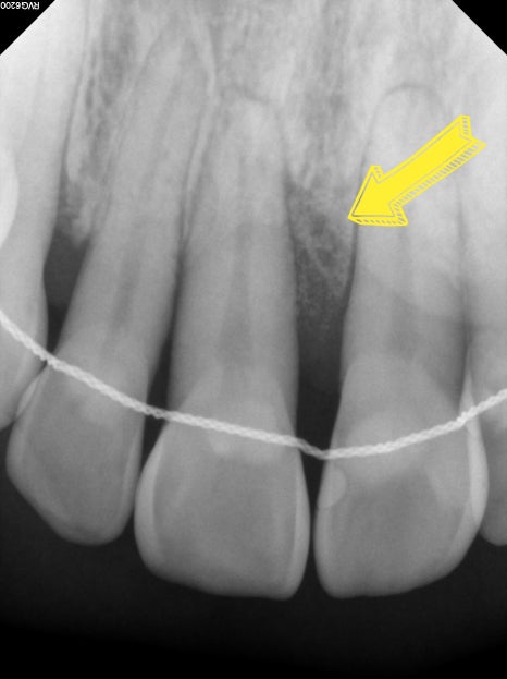 잇몸뼈 재생을 돕는 치주 재생 유도제, 엠도게인 관련 이미지 5