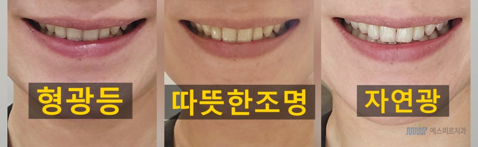 ✨앞니 색상, 자연스럽게? 새하얗게? 고민된다면 - 미라클네이트 관련 이미지 4