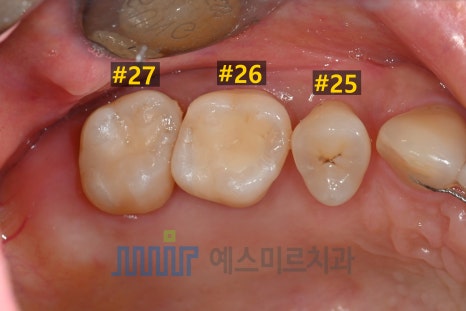 ๐ฆท ์น์์ ๊น๋ง ์ ์ด ๋ณด์ฌ์! - ์๋๋ฏน ์ธ๋ผ๋ฏน ์ธ๋ ์ด ๊ด๋ จ ์ด๋ฏธ์ง 9