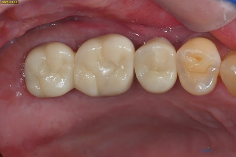잇몸 염증이 코까지 번졌다고요? - 상악동거상술 + 뼈이식 관련 이미지 14