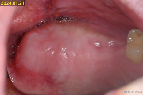잇몸 염증이 코까지 번졌다고요? - 상악동거상술 + 뼈이식 관련 이미지 10
