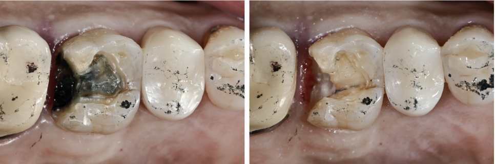 금이 간 치아! 치아를 잃을 뻔 했던 순간, 예스미르치과 관련 이미지 3