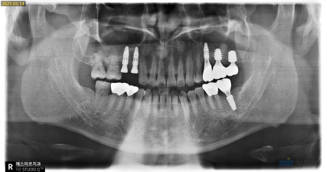 잇몸 염증이 코까지 번졌다고요? - 상악동거상술 + 뼈이식 관련 이미지 12