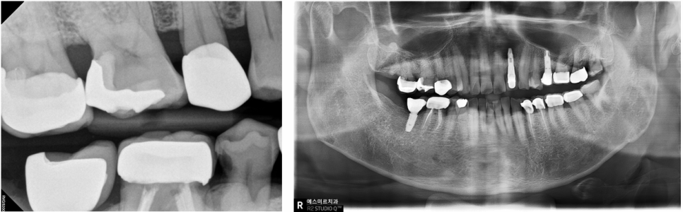 금이 간 치아! 치아를 잃을 뻔 했던 순간, 예스미르치과 관련 이미지 2