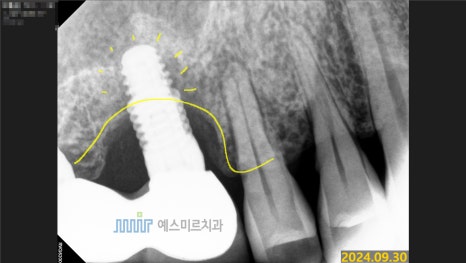 임플란트가 흔들려요 - 임플란트 재수술 관련 이미지 2