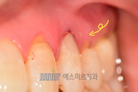 💡 치아 뿌리 근처가 패였어요 &ndash; 치경부 마모증 & 레진치료 관련 이미지 4