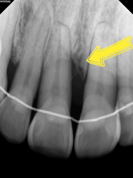 잇몸뼈 재생을 돕는 치주 재생 유도제, 엠도게인 관련 이미지 4