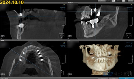 임플란트가 흔들려요 - 임플란트 재수술 관련 이미지 6