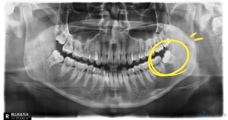 사랑니 발치, 꼭 빼야 할까요? - 사랑니 발치 관련 이미지 3