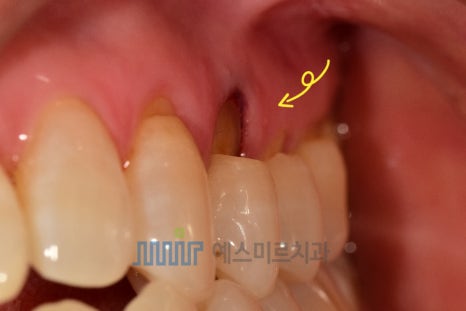 💡 치아 뿌리 근처가 패였어요 &ndash; 치경부 마모증 & 레진치료 관련 이미지 3