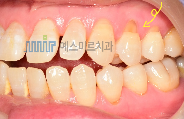 💡 치아 뿌리 근처가 패였어요 &ndash; 치경부 마모증 & 레진치료 관련 이미지 1