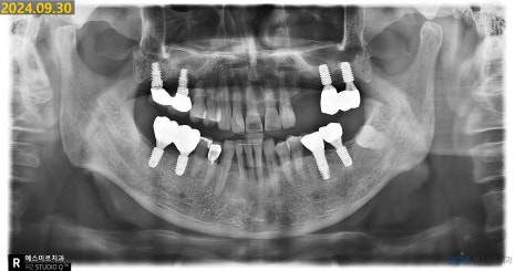 임플란트가 흔들려요 - 임플란트 재수술 관련 이미지 9