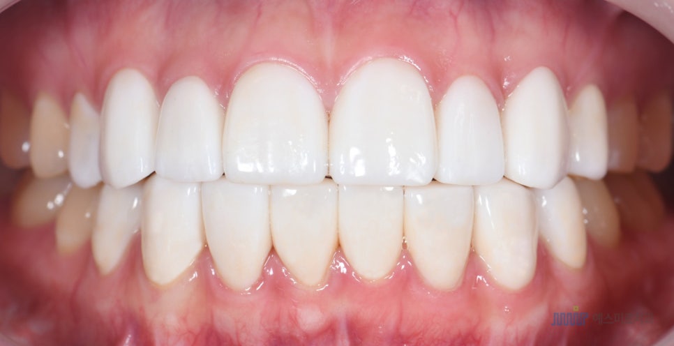 ✨앞니 색상, 자연스럽게? 새하얗게? 고민된다면 - 미라클네이트 관련 이미지 6